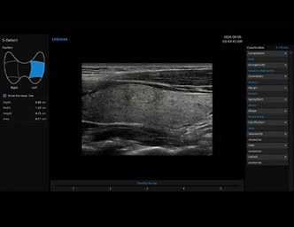 S Detect For Thyroid